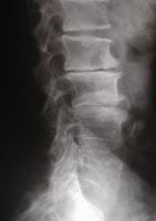 Canal lumbar estrecho por artrosis articular posterior, raquis lumbar de perfil