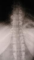 Enfermedad de Forestier y artrosis dorsal,   raquis dorsal de frente