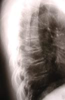 Enfermedad de Forestier y artrosis dorsal,   raquis dorsal de perfil