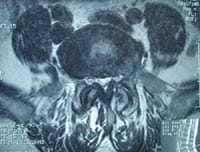 Canal lumbar estrecho por artrosis articular posterior, resonancia magnética secuencia T2, corte transversal