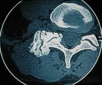 Artrosis interarticular posterior unilateral