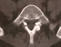 Lisis ístmica y artrosis articular posterior