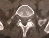 Lisis ístmica y artrosis articular posterior