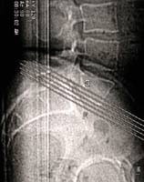 Espondilolistesis por lisis ístmica L5, y artrosis articular posterior, TDM scout view