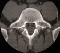 Espondilolistesis por lisis ístmica L5, y artrosis articular posterior