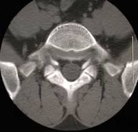 Espondilolistesis por lisis ístmica L5, y artrosis articular posterior