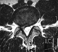 Discopatía lumbar.  Resonancia magnética en T2 corte.