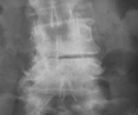 Discoartrosis pseudopótica L4-L5 con pinzamiento discal, condensación en espejo y erosiones de la parte derecha de las plataformas vertebrales (flechas) en un paciente diabético.