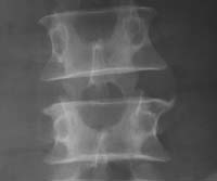 Osteofitos aislados sin pinzamiento discal