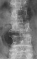 Artrosis lumbar banal, se conserva la altura del disco L3-L4, el osteofito se inserta en el flanco del cuerpo vertebral a pocos milímetros de distancia del borde de la plataforma
