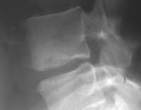 Discoartosis L4-L5 con pinzamiento discal y osteofitosis anterior desplazada respecto a las plataformas vertebrales (&quot;osteofito de tracción de Mac Nab) (flechas) considerada como un signo indirecto de inestabilidad invertebral.