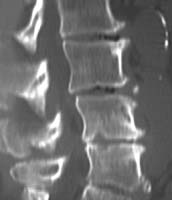Discoartrosis L4-L5 con geodas de las plataformas vertebrales y osteofitosis desplazada de Mac Nab (flechas). Retrolistesis artrósica L3-L4 con vacío discal (cabeza de la flecha).