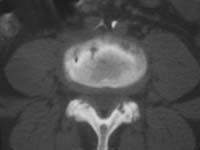 Imagen tomodensitométrica por el espacio L4-L5 que muestra erosiones de las plataformas vertebrales (flechas) y una artrosis articular posterior con pinzamiento articular.
