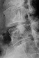 Artrosis de la articulación interapofisaria posterior L3-L4 con pinzamiento de la interlínea articular y condensación ósea subcondral