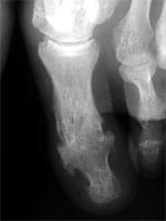 Erosión marginal de la metatarsofalángica del dedo gordo, artritis anquilosante de la interfalángica del dedo gordo con hiperostosis de la 2a falange