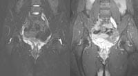 Coxitis bilateral con derrame intraarticular y contraste de la sinovial de las dos articulaciones coxofemorales