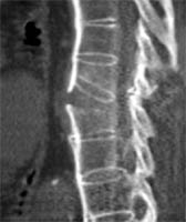 TAC raquídeo: fractura vertebral con discontinuidad de la anquilosis vertebral