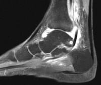 Artritis del tobillo: sinovitis tibiotaliana y tenosinovitis tibial posterior con placa edematosa en la parte posterior del maléolo interno