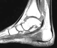 Artritis del tobillo: sinovitis tibiotaliana y tenosinovitis tibial posterior con placa edematosa en la parte posterior del maléolo interno