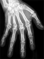 Artritis erosivas asimétricas que afectan en particular a las interfalángicas distales, carpitis