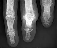 Artritis erosiva y anquilosante de las articulaciones interfalángicas