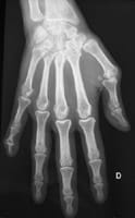Espondiloartropatía: Reumatismo psoriásico.  Artritis MCP pulgar e IFD del 5º dedo (A).
