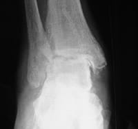 Espondiloartropatía: Reumatismo psoriásico  Artritis tibiotaliana con pinzamiento de la interlínea (P) y erosión subcondral (E)