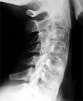 Artritis interapofisaria posterior, anquilosis de los cuerpos vertebrales