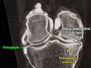 Arthrography osteoarthritis femoro tibial