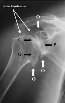 critères diagnostiques radiographie arthrose