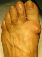 examen clinique arthrose des pieds hallux rigidus