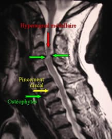 myelopathie cervicarthrosique