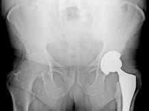 radiography hip prothesis