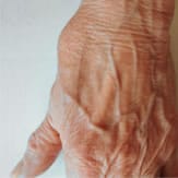clinical examination Osteoarthritis of the hands