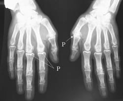 traitements chirurgicaux arthrose main