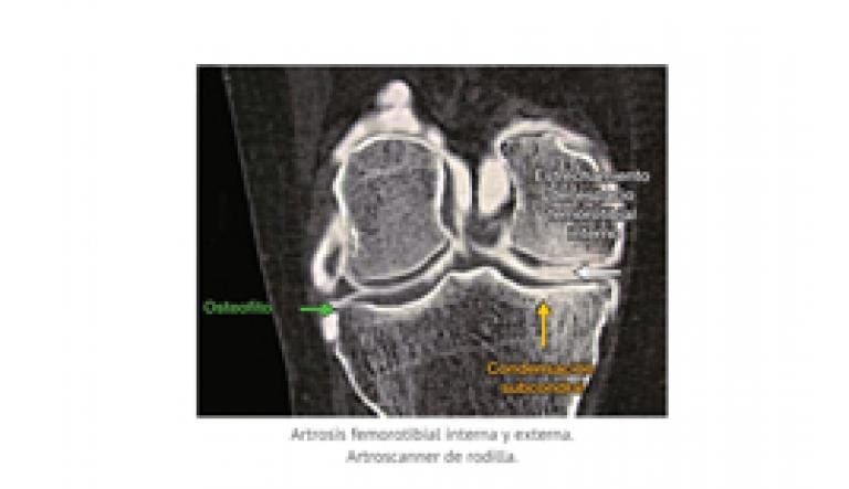 La fisiopatologia de la artrosis
