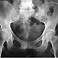 Coxo femoral, imagen estándar