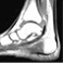 Artritis del tobillo: sinovitis tibiotaliana y tenosinovitis tibial