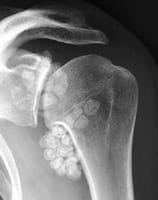 Omartrosis secundaria con condromatosis sinovial Omartrosis secundaria con condromatosis sinovial