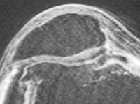 Corte axial SE con FS e inyección de gadolinio Corte axial SE con FS e inyección de gadolinio
