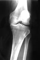 Pinzamiento importante del compartimento interno con osteocondensación en genu varum Pinzamiento importante del compartimento interno con osteocondensación en genu varum