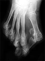 Antepié triangular, luxación de las articulaciones metacarpofalángicas, hallus valgus, quintus varus Antepié triangular, luxación de las articulaciones metacarpofalángicas, hallus valgus, quintus varus