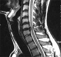 Cervicalgias hernia discal y artrosis por Resonancia magnética T2 Cervicalgias hernia discal y artrosis por Resonancia magnética T2