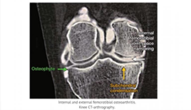 Pathophysiology of osteoarthritis